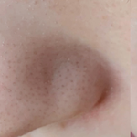 지성<b>인드라</b> 블랙헤드 탈출 자랑 좀 할게---!