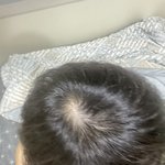 <b>탈모</b> 많이 심한가요
