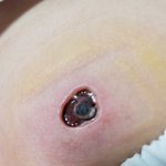 8살아이 해열주사잘못맞고 괴사..사진있어요!