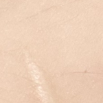 이거 <b>흉터</b> 없앨 수 있나...?