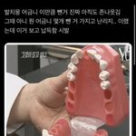 나 어금니 상태안좋아서 뽑고왔는데 <b>엠씨</b>몽