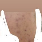 내 피부 변천사볼 사람 개좋아짐(약혐)