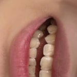 나 앞니깨진거..많이 <b>티나</b>?