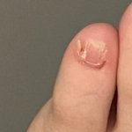 [혐주의] 새끼<b>발톱</b> 이따구인건 어떻게 해야돼??? 들어오자마자 바로...