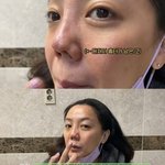 고은아 코 수술 후기