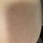 [꼭조언부탁] 피부에 이게 대체 뭐야..? (사진주의)