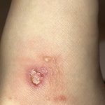 크록스 안 맞는 발은 신으면 <b>이러</b>케 된다…(약혐주의