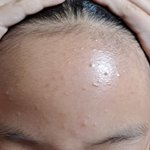 이정도 여드름도 <b>로아</b>큐탄 받을수 있음?