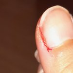 나 손톱에서 <b>피나</b>