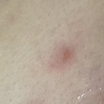 [19] 여드름 <b>흉터</b> 잘 아는 애들아 한 번만 들어와줘ㅠ