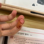 <b>판녀</b> 다쳐서 피남 ㅜㅜ