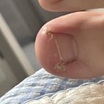 나 발톱이런데 <b>내성</b>발톱임?