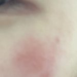 접촉성<b>피부염</b> 이렇게 하면 완전 좋음