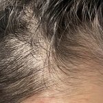 나 <b>탈모</b>야 ..?!!ㅠㅠㅠㅠㅠㅠㅠ