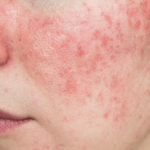 안면<b>홍조</b>인줄 ㅠㅠ