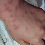 난 <b>빈대</b>한테 물린줄 몰랐음