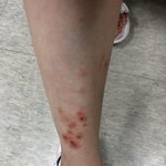 [이것좀봐줘] <b>빈대</b> 물린거 맞죠