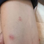 이거 혹시 <b>빈대</b> 물린 걸까요?(사진주의)