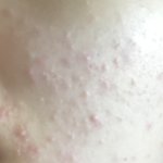 이거 <b>모낭염</b>임?? ㅎㅇㅈㅇ