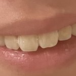 입꼬리 비대칭 진짜… <b>우야</b>면좋냐