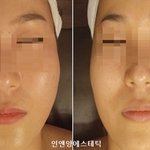 [댓글부탁해] 이런 얼굴형은 광대<b>축소</b>를 해야함?
