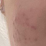 근데 여드름때문에 다니는 <b>피부과</b>는