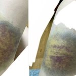 '<b>무료</b> 과외' 해준다더니…피멍 들도록 맞은 수험생