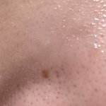 와 나 블랙헤드 <b>박멸</b>함