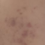 나 여드름 어캐 해야 <b>사라</b>질까?