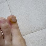 [댓글부탁해] 샵에서 내성발톱 관리후 <b>염증</b>이생겼어요