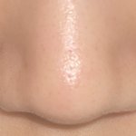 블랙헤드 심한애들