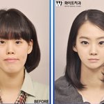 성형 <b>전후</b> 실화야?