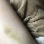 원래 <b>링겔</b> 멍 이렇게 오래남음??