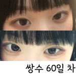나 <b>쌍수</b>하고 싶은데