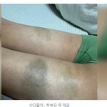 "막대기로 때려 피멍 들었다".. 경찰, 초등교사 아동학대 의혹...