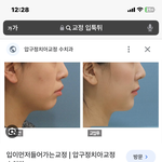 아니 <b>돌출</b>입 교정 보는데