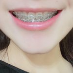 다들 치아교정 만족함?