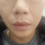 [꼭조언부탁] 대전 ㅂㄹㅂㅇㅇ필러후기.내돈주고 <b>고질라</b>되기ㅡㅡ