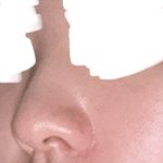 [댓글부탁해] 사진첨부) 코<b>성형</b> 할까말까?