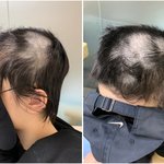 딸이 머리가 <b>바리캉</b>에 밀린 채 구조되었습니다. 제발 도와주세요.