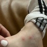 <b>빈대</b> 물린 자국인지 좀 봐주세요 ㅜㅜ