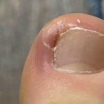 내성<b>발톱</b> 병ㅇ원 급해..