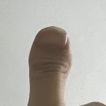 손가락 <b>단지증</b> 어떻게 고침ㅠㅠ