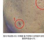 이런 여드름 <b>자국</b>