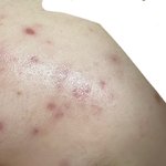 피지,여드름 없애는 법 알려줌