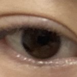 [드루와] 쌍수한지 1년 넘었는데 아직도 한<b>달차</b>눈같음