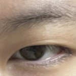 이마<b>거상</b> 10일차 수술 전후