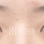 [댓글부탁해] <b>이런눈</b>은 쌍수하면 안됨?
