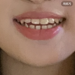 [댓글부탁해] 치열 개못생김..교정해여핳까