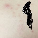 얘들아 이거 혹시 <b>모낭염</b>이니